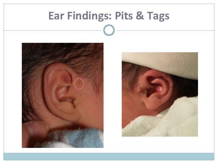 Ear Findings: Pits & Tags 