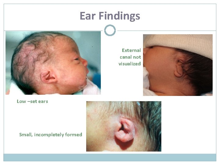 Ear Findings External canal not visualized Low –set ears Small, incompletely formed 