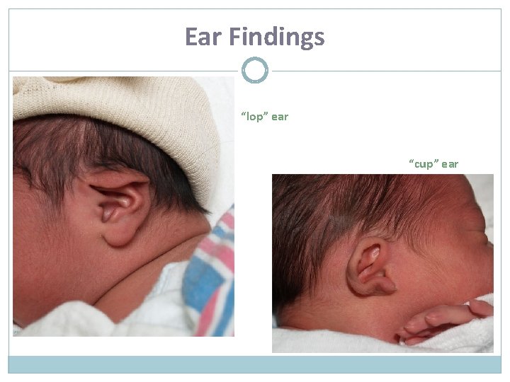 Ear Findings “lop” ear “cup” ear 