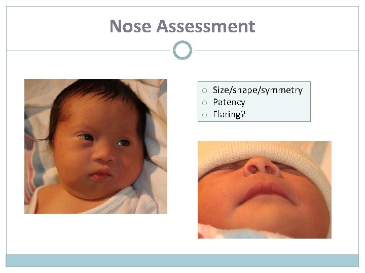 Nose Assessment o Size/shape/symmetry o Patency o Flaring? 