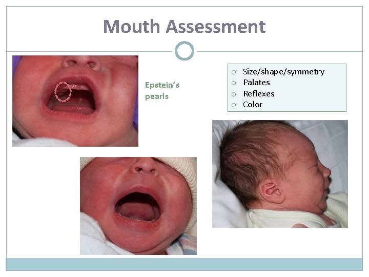 Mouth Assessment Epstein’s pearls o o Size/shape/symmetry Palates Reflexes Color 