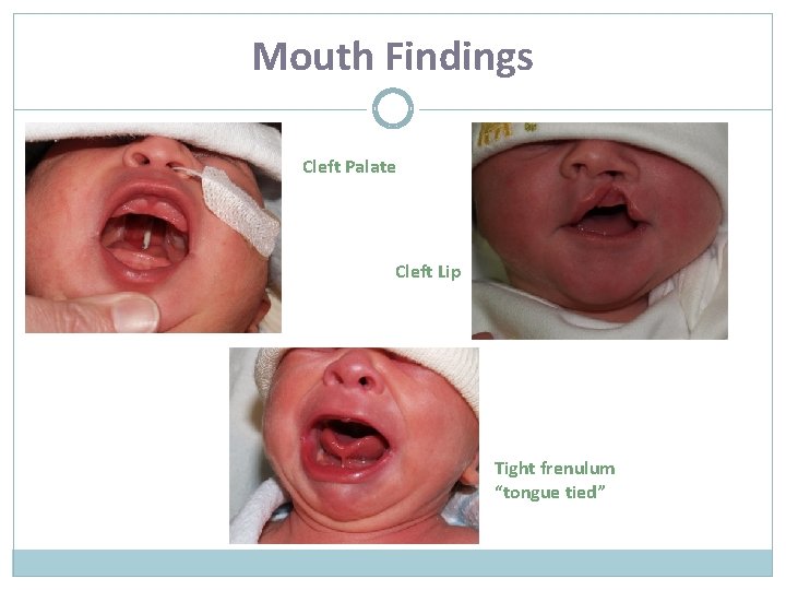 Mouth Findings Cleft Palate Cleft Lip Tight frenulum “tongue tied” 