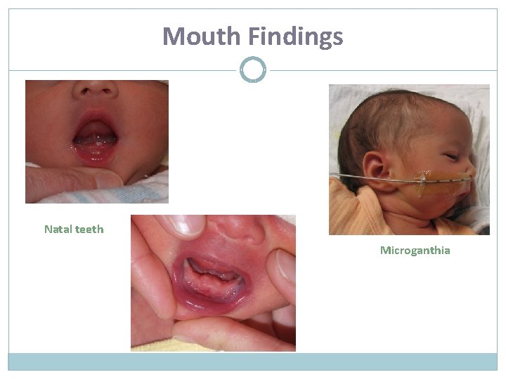 Mouth Findings Natal teeth Microganthia 