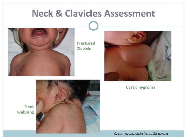 Neck & Clavicles Assessment Fractured Clavicle Cystic hygroma Neck webbing Cystic hygroma photo from