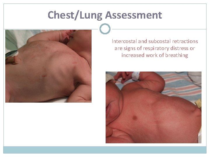 Chest/Lung Assessment Intercostal and subcostal retractions are signs of respiratory distress or increased work