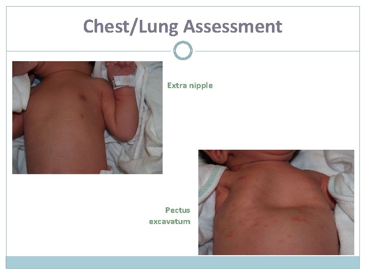 Chest/Lung Assessment Extra nipple Pectus excavatum 
