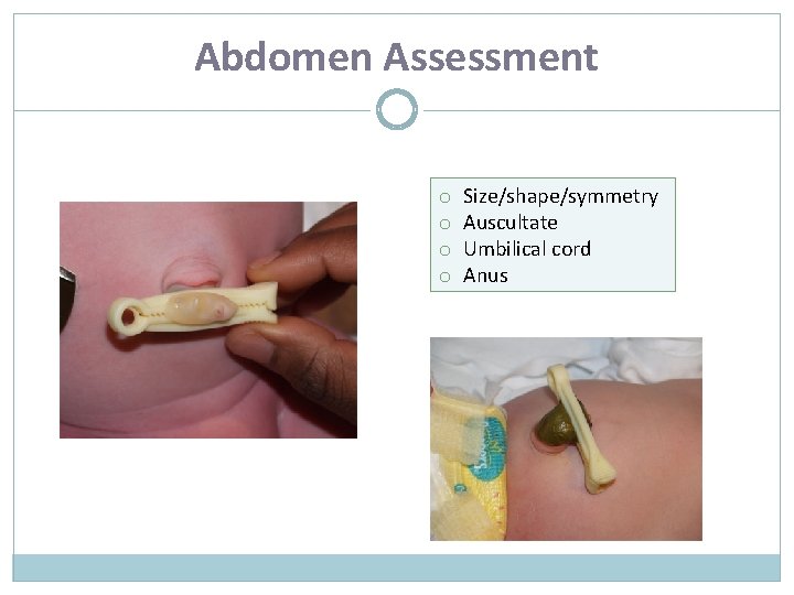 Abdomen Assessment o o Size/shape/symmetry Auscultate Umbilical cord Anus 