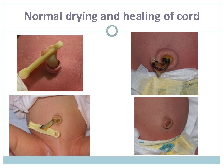 Normal drying and healing of cord 