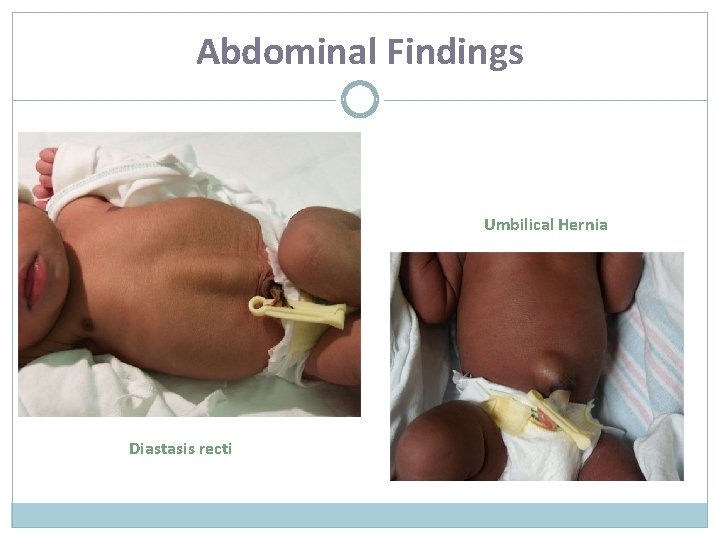 Abdominal Findings Umbilical Hernia Diastasis recti 