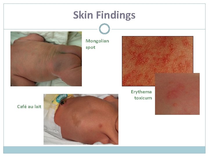 Skin Findings Mongolian spot Erythema toxicum Café au lait 