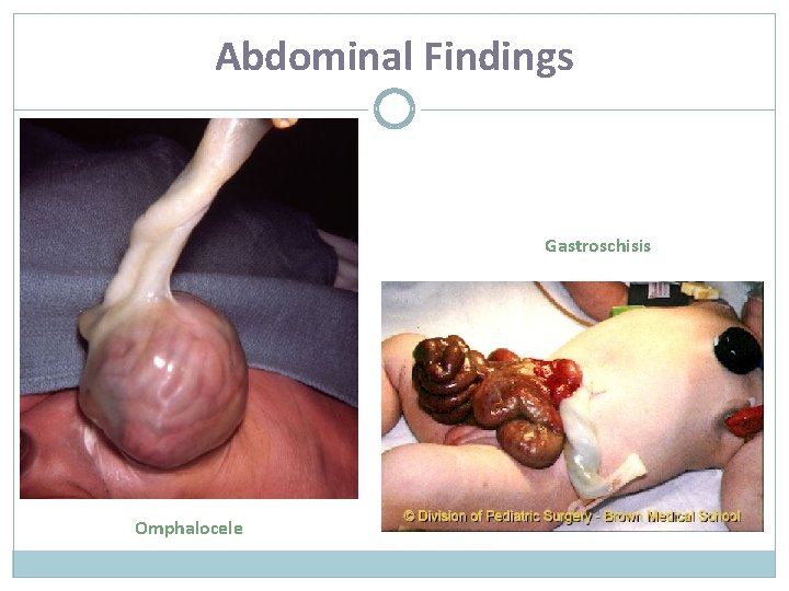 Abdominal Findings Gastroschisis Omphalocele 