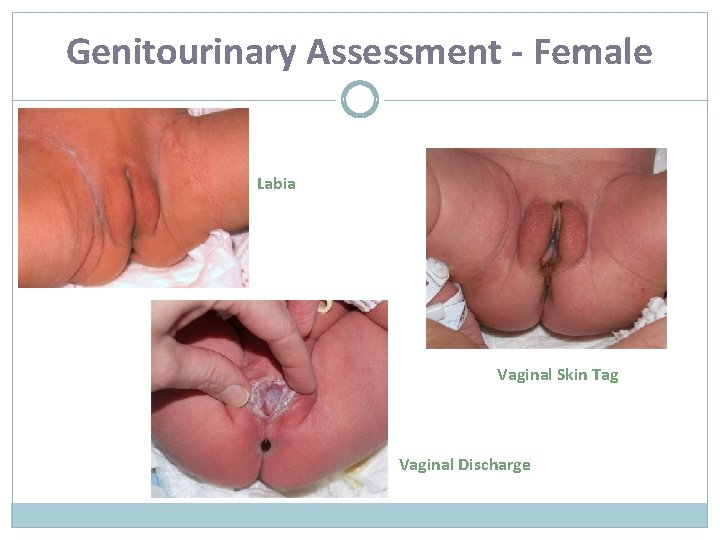 Genitourinary Assessment - Female Labia Vaginal Skin Tag Vaginal Discharge 