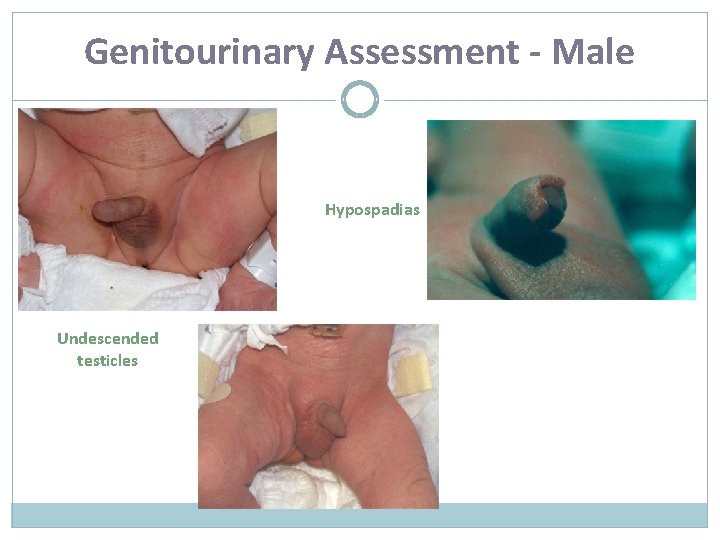 Genitourinary Assessment - Male Hypospadias Undescended testicles 