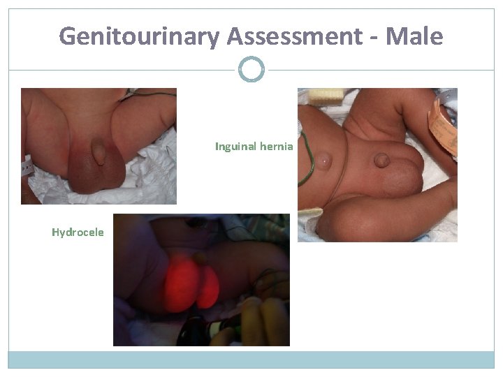 Genitourinary Assessment - Male Inguinal hernia Hydrocele 