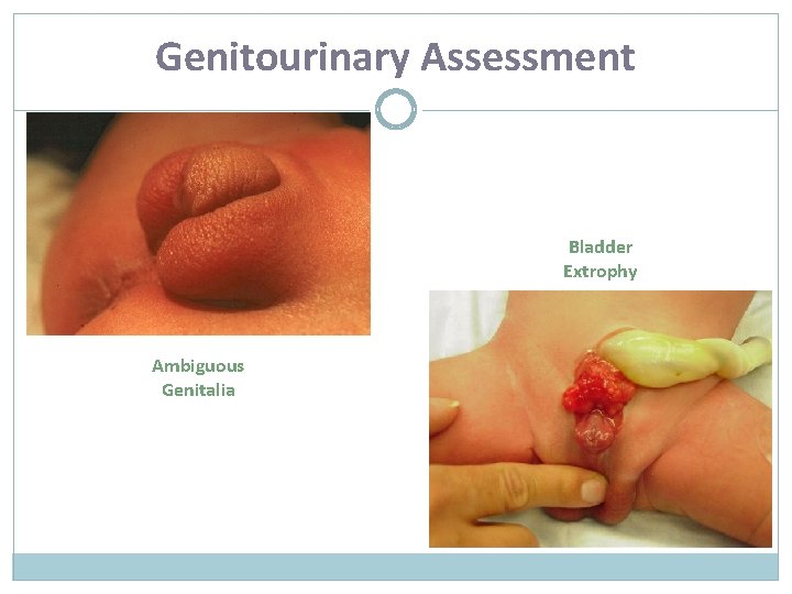 Genitourinary Assessment Bladder Extrophy Ambiguous Genitalia 