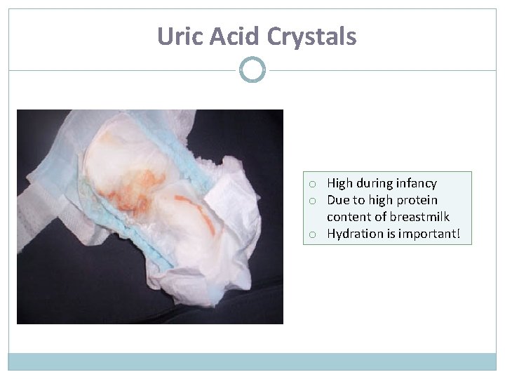 Uric Acid Crystals o High during infancy o Due to high protein content of