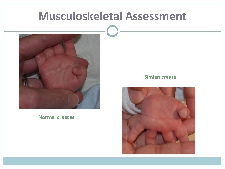 Musculoskeletal Assessment Simian crease Normal creases 