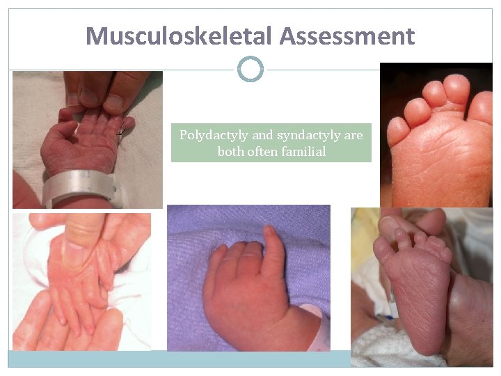 Musculoskeletal Assessment Polydactyly and syndactyly are both often familial 