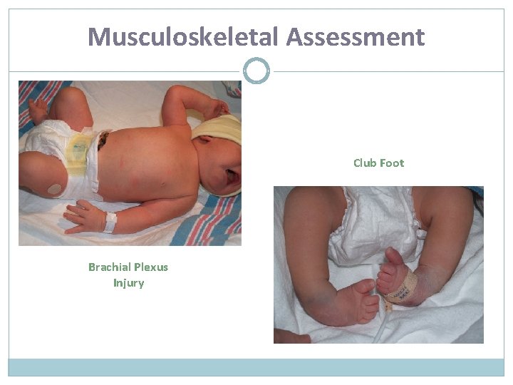 Musculoskeletal Assessment Club Foot Brachial Plexus Injury 