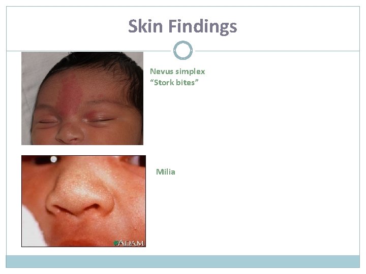 Skin Findings Nevus simplex “Stork bites” Milia 