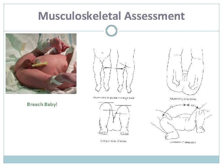 Musculoskeletal Assessment Breech Baby! 