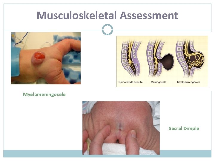 Musculoskeletal Assessment Myelomeningocele Sacral Dimple 