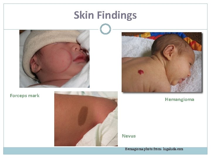 Skin Findings Forceps mark Hemangioma Nevus Hemagioma photo from: lugaluda. com 