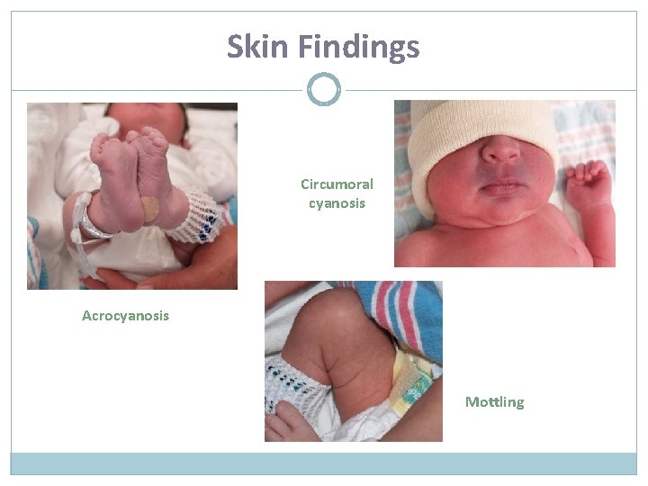 Skin Findings Circumoral cyanosis Acrocyanosis Mottling 