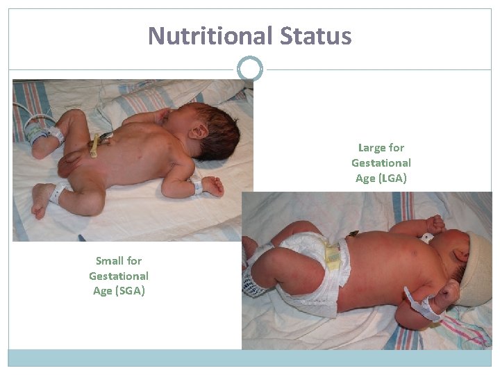 Nutritional Status Large for Gestational Age (LGA) Small for Gestational Age (SGA) 