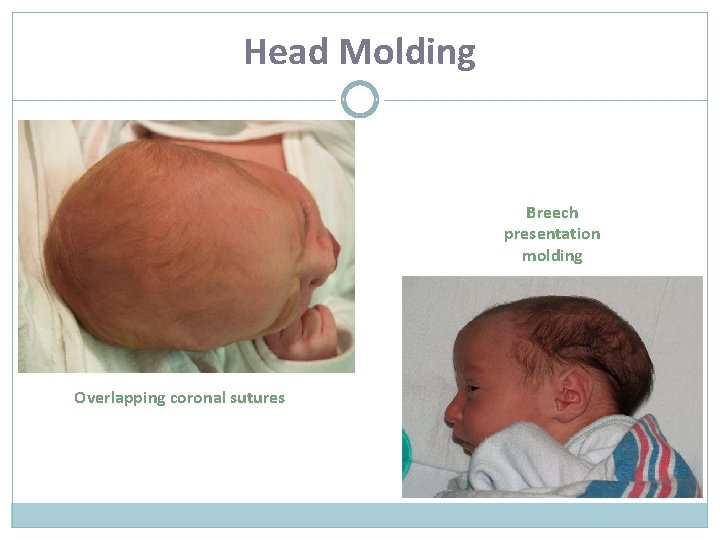 Head Molding Breech presentation molding Overlapping coronal sutures 