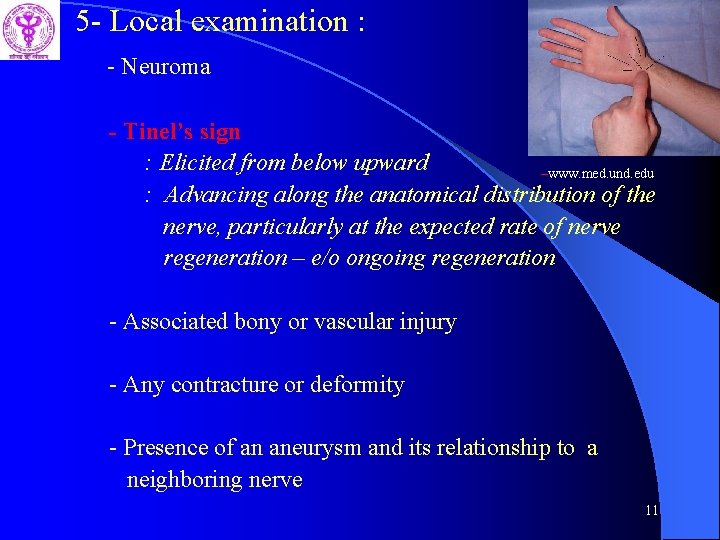 5 - Local examination : - Neuroma - Tinel’s sign : Elicited from below