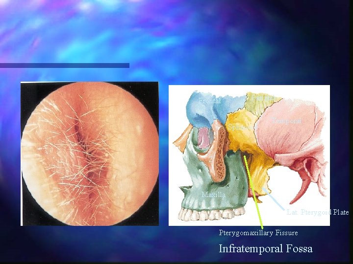 Frontal Parietal Sphenoid Temporal Z Maxilla Lat. Pterygoid Plate Pterygomaxillary Fissure Infratemporal Fossa 