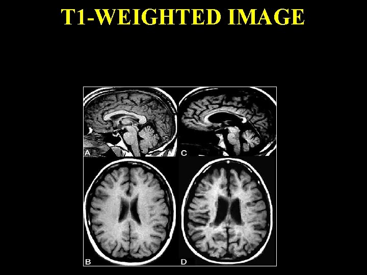 T 1 -WEIGHTED IMAGE In the figure below, patient on the left is a