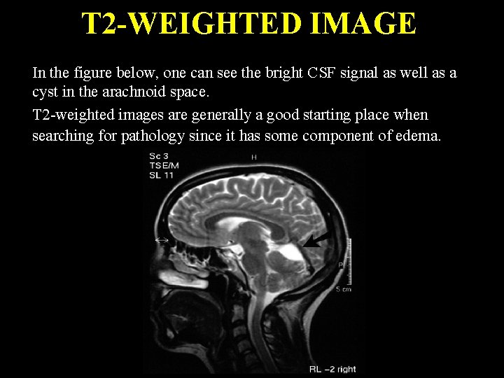 T 2 -WEIGHTED IMAGE In the figure below, one can see the bright CSF