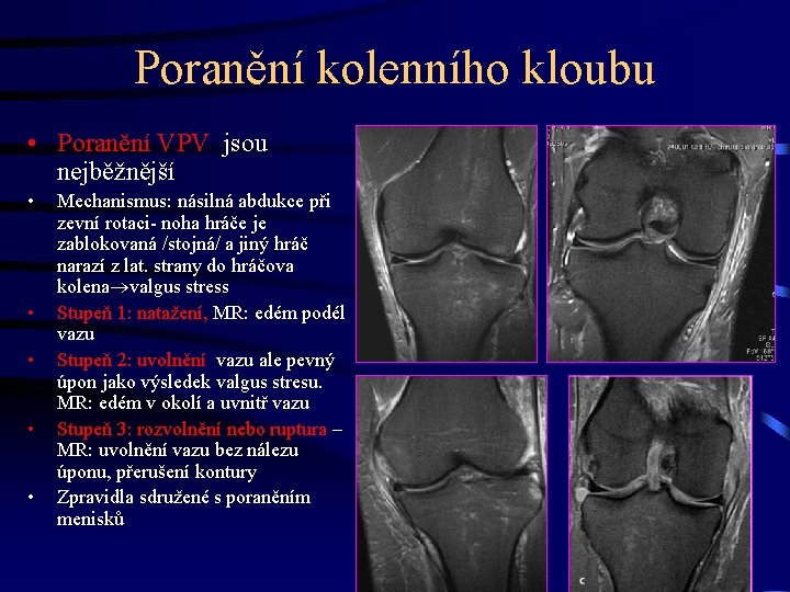 Poranění kolenního kloubu • Poranění VPV jsou nejběžnější • • • Mechanismus: násilná abdukce