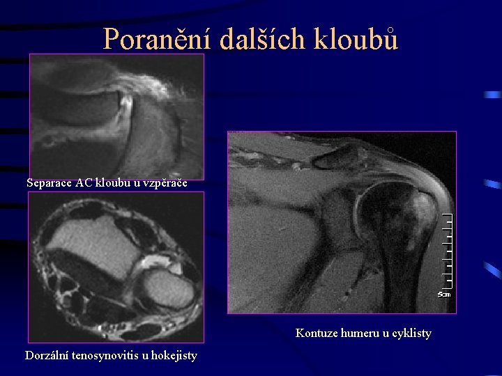 Poranění dalších kloubů Separace AC kloubu u vzpěrače Kontuze humeru u cyklisty Dorzální tenosynovitis