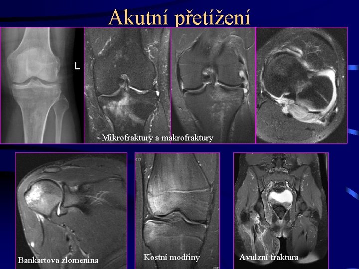 Akutní přetížení Mikrofraktury a makrofraktury Bankartova zlomenina Kostní modřiny Avulzní fraktura 