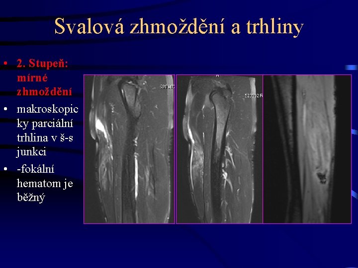 Svalová zhmoždění a trhliny • 2. Stupeň: mírné zhmoždění • makroskopic ky parciální trhlina