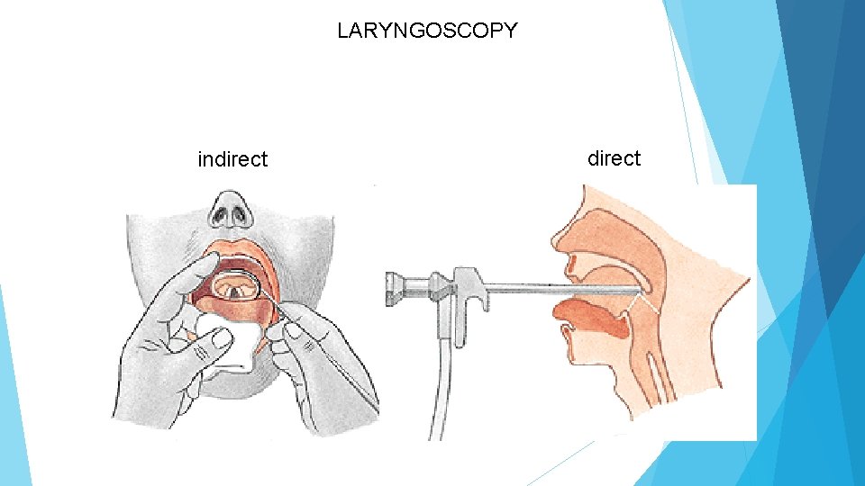 LARYNGOSCOPY indirect 