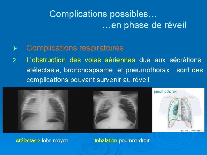 Complications possibles… …en phase de réveil Ø Complications respiratoires 2. L’obstruction des voies aériennes