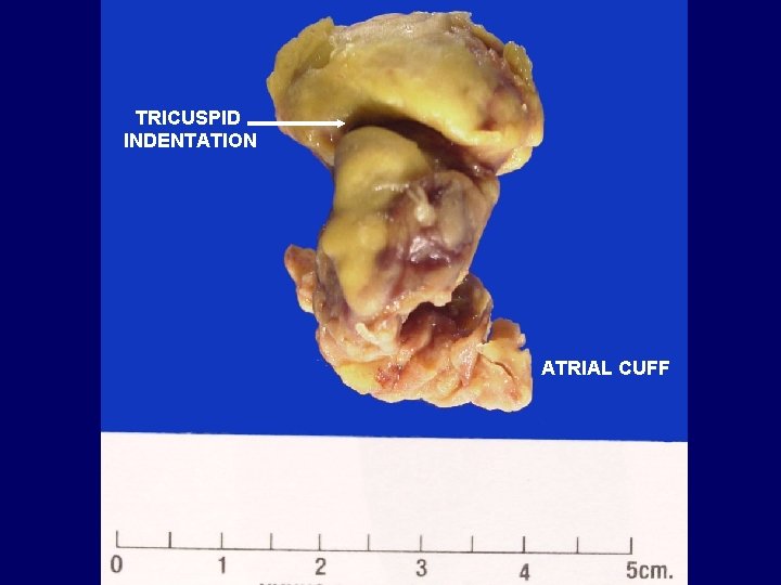 TRICUSPID INDENTATION ATRIAL CUFF TRICUSPID INDENTATION ATRIAL CUFF
