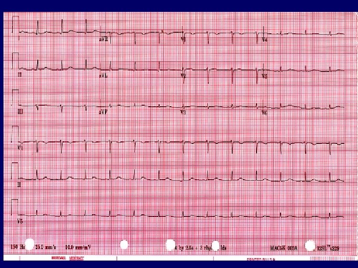 ECG ECG