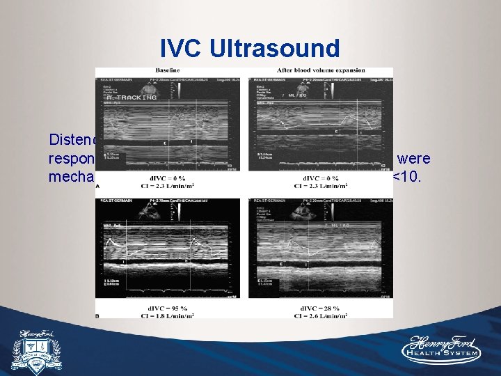 IVC Ultrasound Distendibility index of IVC of >=15% predicted fluid responsiveness in 2 small