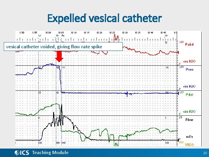 Expelled vesical catheter voided, giving flow rate spike Teaching Module 10 