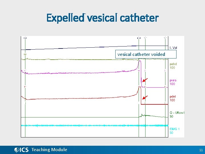 Expelled vesical catheter voided Teaching Module 11 
