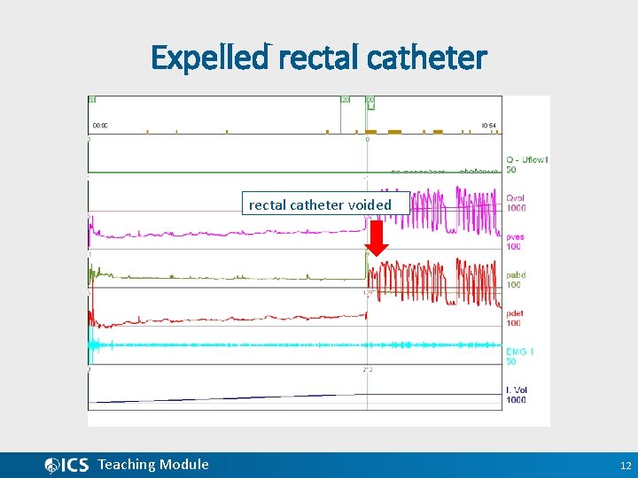 Expelled rectal catheter voided Teaching Module 12 