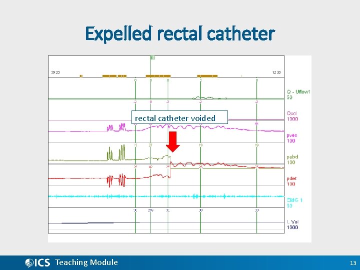 Expelled rectal catheter voided Teaching Module 13 