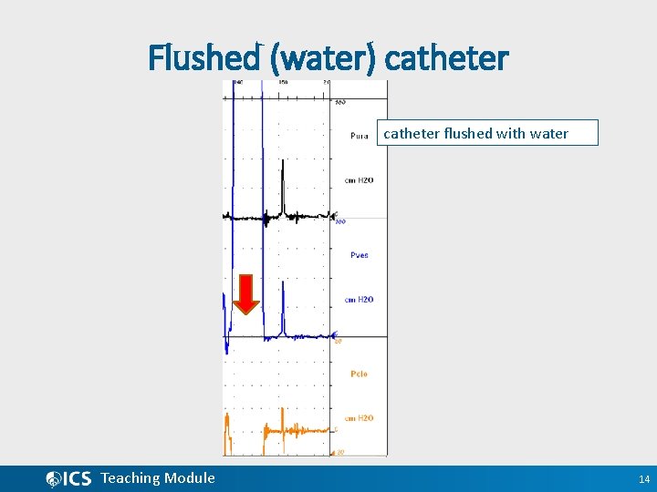 Flushed (water) catheter flushed with water Teaching Module 14 