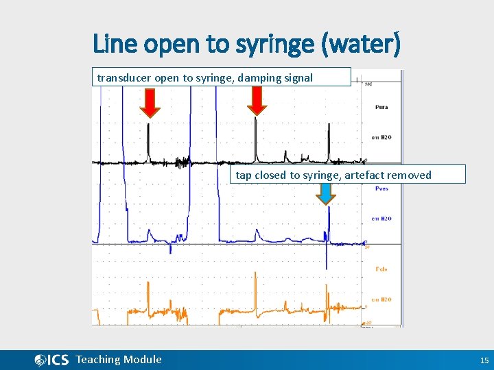 Line open to syringe (water) transducer open to syringe, damping signal tap closed to