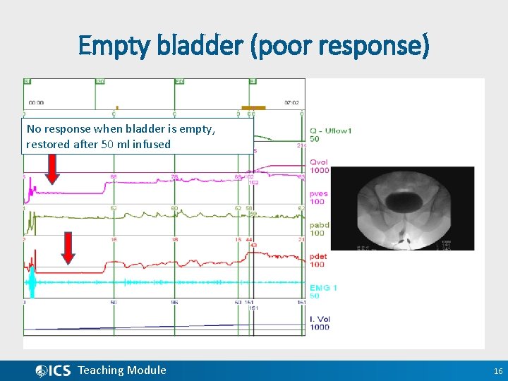 Empty bladder (poor response) No response when bladder is empty, restored after 50 ml